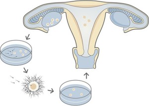 In-vitro_fertilization_IVF